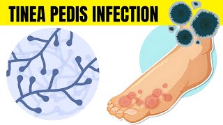 Tinea Pedis Infection Athletes Foot  Causes Types Signs amp Symptoms And Treatment [upl. by Rosemaria]