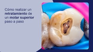 Cómo realizar un retratamiento de un molar superior paso a paso [upl. by Eleonora92]