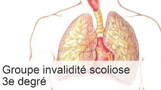 Quel groupe dinvalidité en cas de scoliose de grade 3  conditions de traitement [upl. by Cerveny]