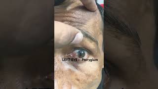 Pterygium [upl. by Peers298]