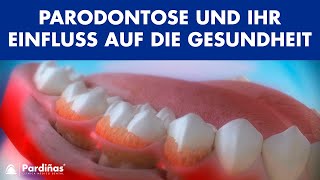 Parodontose und ihr Einfluss auf die Gesundheit © [upl. by Akirdnuhs]