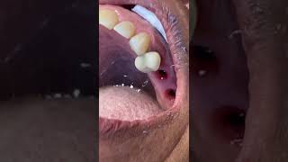 Doctor Tips an instructional video closedtray impression tissue guide Neodent GM implants [upl. by Ecirtnahs]