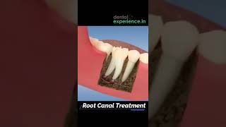 Root Canal Treatment  Dental experiencein [upl. by Mendelson]