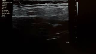 suprascapular nerve block 24110101 [upl. by Augie]