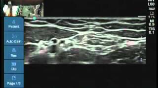 Ultrasound location of medial cutaneous nerve of forearm [upl. by Lorin]