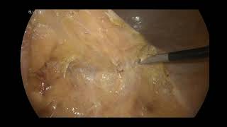 Laparoscopic left colectomy for sigmoid adenocarcinoma [upl. by Eiramave405]