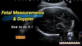 Fetal measurements and Doppler  How to do it [upl. by Nadual342]