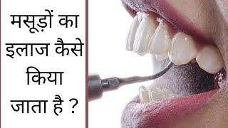 मसूड़ों का इलाज कैसे कर सकते हैं  आइए जानते हैं centerofdentaltreatment [upl. by Gabrielson]