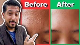 How to Rid Fungal Acne  Fungal Acne Treatment THAT WORKS for Malassezia Folliculitis [upl. by Patty]