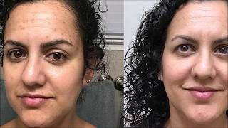 Meladerm Before and After Pictures Amazing Results [upl. by Bevis]