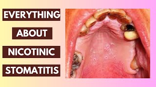 Nicotinic Stomatitis Explained Causes Symptoms and Treatment Options  InDepth Lecture [upl. by Remington]