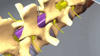 What to expect during an Epidural Steroid Injection at RAYUS [upl. by Horbal]