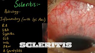 SCLERITIS  Diference between Scleritis and Episcleritis  Part 2 [upl. by Odyssey]