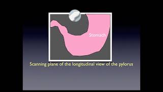 Pyloric Stenosis [upl. by Eidna]