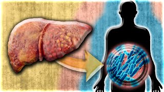 Is Fatty Liver causing your SIBO or Candida [upl. by Jacqui]