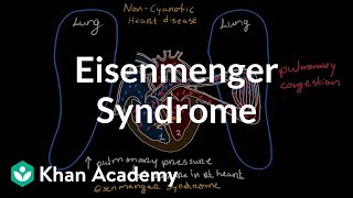 What is Eisenmenger syndrome  Circulatory System and Disease  NCLEXRN  Khan Academy [upl. by Daune290]