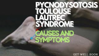 Pycnodysostosis Toulouse Lautrec Syndrome  Causes and Symptoms [upl. by Ardnosal]