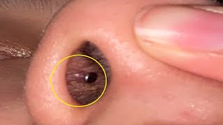 how to get rid of a piercing bump inside your nose naturally [upl. by Crifasi]