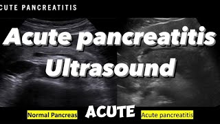 Acute pancreatitis ultrasonographic findings Pancreas ultrasound part II [upl. by Agosto]