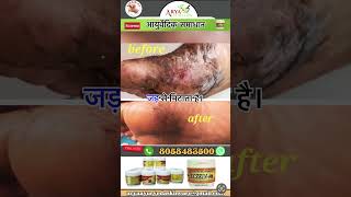 Eczema ayurvedic skin care [upl. by Horowitz]