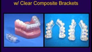 Powerprox Six Month Braces® Digital Setup and Reprox  IPR Guide amp Indirect Bonding [upl. by Brigham]