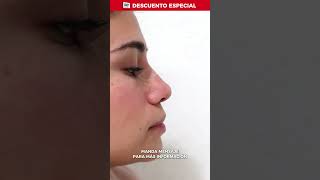 ANTES Y DESPUÉS RINOMODELACIÓN BuenFin2024 rinomodelacion rinoplastia belleza antesydespues [upl. by Tracey]