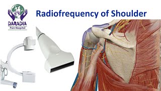 Shoulder Joint Radiofrequency Procedure  Cooled RF of shulder [upl. by Mommy]