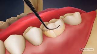 Video Tutorial Dental Scaling [upl. by Aihtiekal]