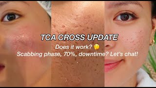 TCA CROSS UPDATE l ACNE SCARS [upl. by Ameehs]