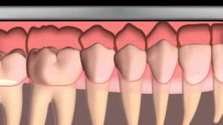 What is a dental impression [upl. by Maida]