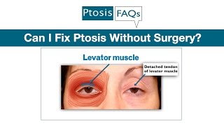 Can I Fix Ptosis Without Surgery [upl. by Pilloff]