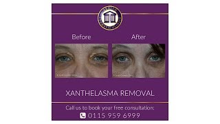 Xanthelasma Removal with Dr Maini [upl. by Refotsirc]