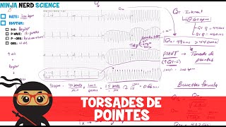 Rate and Rhythm  Torsades de Pointes [upl. by Bradley618]