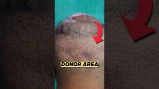 Hair Transplant Result  Fue Hair Transplant [upl. by Aillimac]