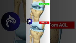 Why ACL Tears are such a nightmare for athletes acl [upl. by Arodaeht]