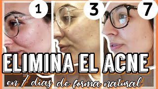 ✅7 DIAS USANDO JABON de AZUFREFUNCIONA  ELIMINA el ACNE muy RÁPIDO de forma NATURAL  JeniG Tv [upl. by Ydnir]