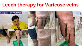 Do leeches help with varicose veins  Do leeches remove blood clots  Leech therapy  9699011786 [upl. by Mallen697]