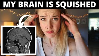 My Brain is SQUISHED My Chiari Malformation Defect [upl. by Gibby]