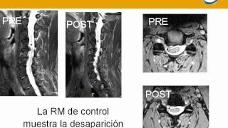 neurorgsnetherniadiscalcervicalabordajeconneuronavegador [upl. by Enalb]