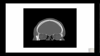 Bony orbital and skull base anatomy pathology in Coronal Plane [upl. by Sirkin]