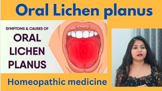 Oral lichen planus treatment  Oral lichen planus symptomscauses amp homeopathic medicine in hindi [upl. by Colwin]