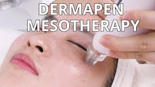 Dermapen Mesotherapy  How Microneedling Treatment Is Done  NV6130 MYCHWAY VIDEO [upl. by Bouldon199]