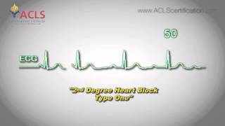 Second Degree Heart Block Type One by ACLS Certification Institute [upl. by Arlo]