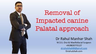 removal of impacted canine palatal approach SD 480p [upl. by Veron]