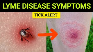 Early Signs of Lyme Disease What to Watch For [upl. by Dj]