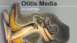 Otitis media Definition of otitis media  classification of otitis media✨ [upl. by Enrichetta]