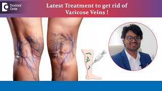 Most advanced treatment for Varicose Veins without surgery   Dr Rohit Madhukar  Doctors Circle [upl. by Arretak554]