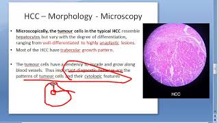 Pathology 635 a Hepato Cellular carcinoma Hepatocellular liver malignant hepatoma HCC cause [upl. by Yreva]