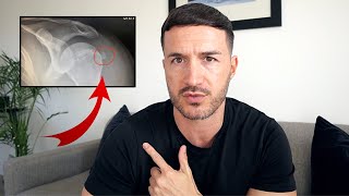 Calcific Tendonitis Shoulder Recovery my 3 year journey [upl. by Ekrub]