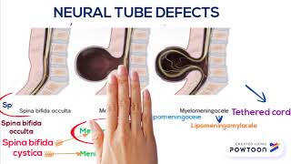 Neural tube defect Neural tube defect [upl. by Aulea]